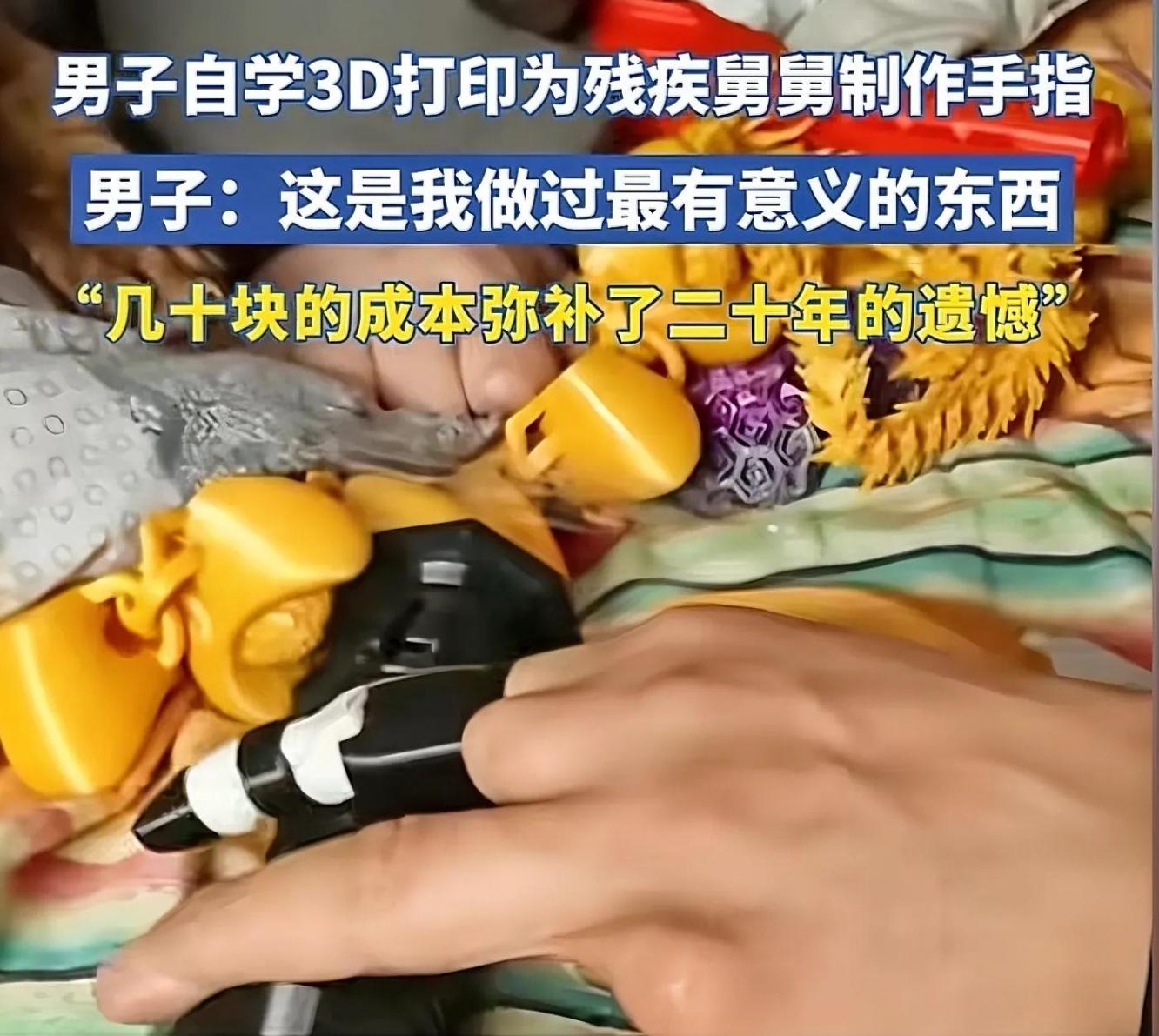 男子用3D打印幫舅舅補上斷指